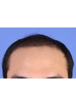 Before Hair Transplant&nbsp;Front